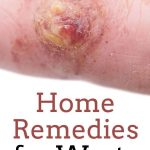 warts remedy | essential oils | oregano | doterra | natural
