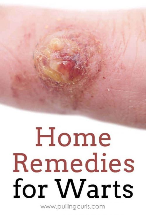 warts remedy | essential oils | oregano | doterra | natural | home