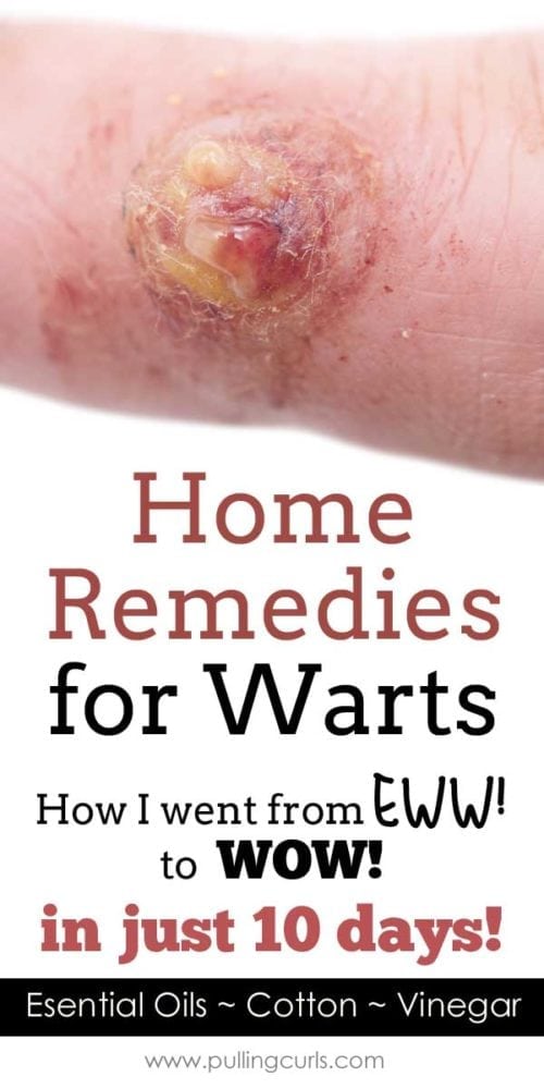how to get rid of warts on hands with essential oils