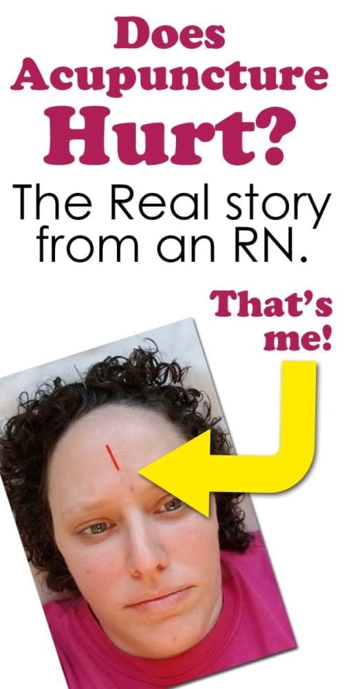 Does Acupuncture hurt? Does acupuncture work?