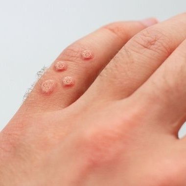 warts on pinky finger