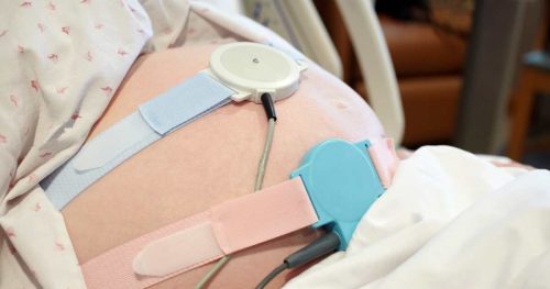 woman with fetal monitors on