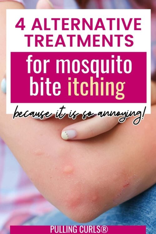 alternatives treatments for mosquito bite itching
